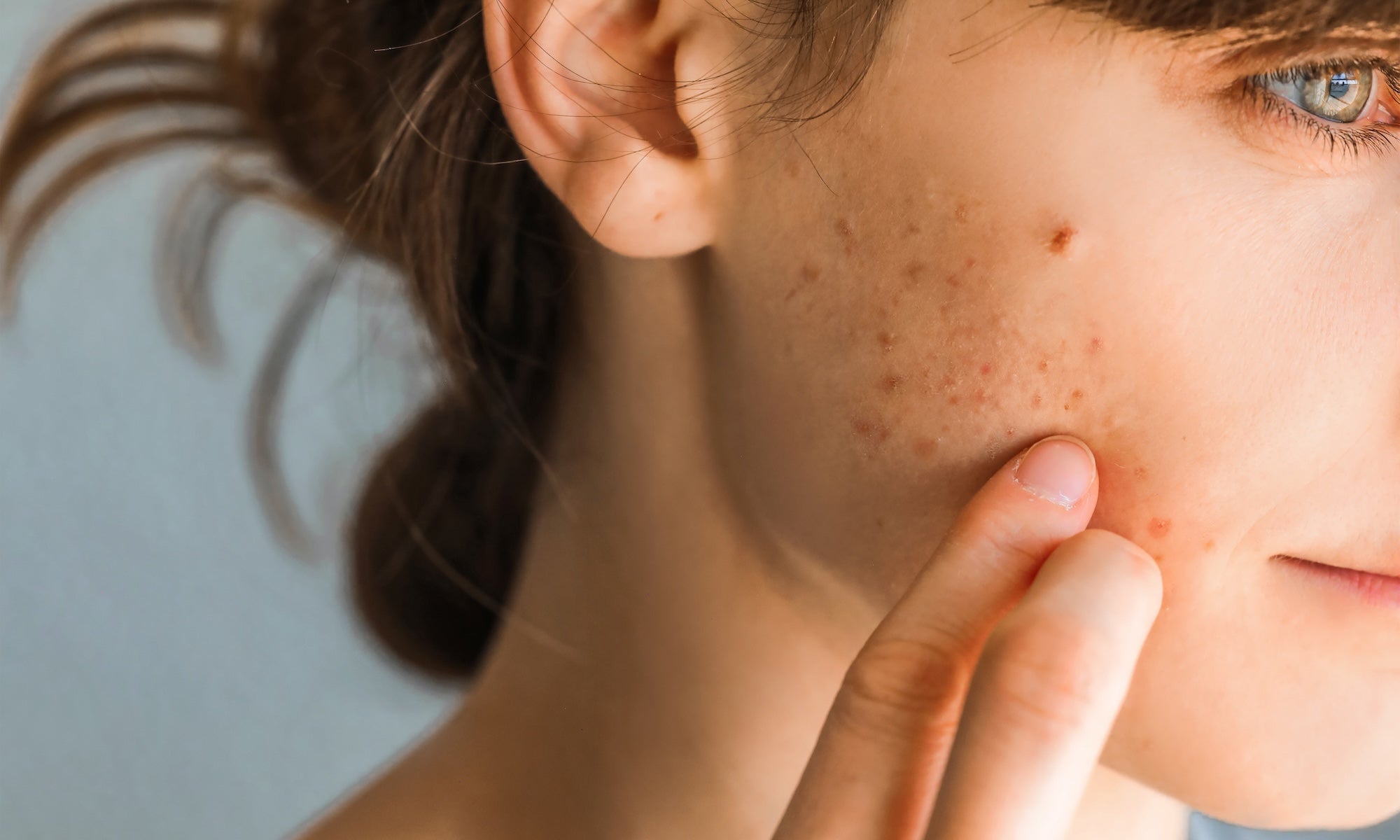 How to Stop Picking at Your Face (and Finally Let Your Skin Clear Up)