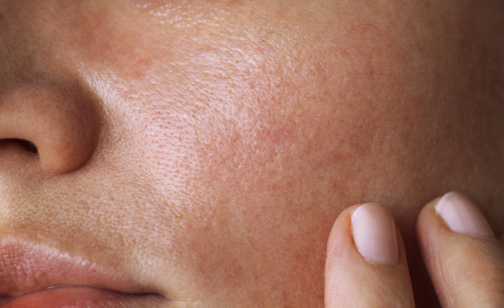 Must-Know Tips for Oily Skin