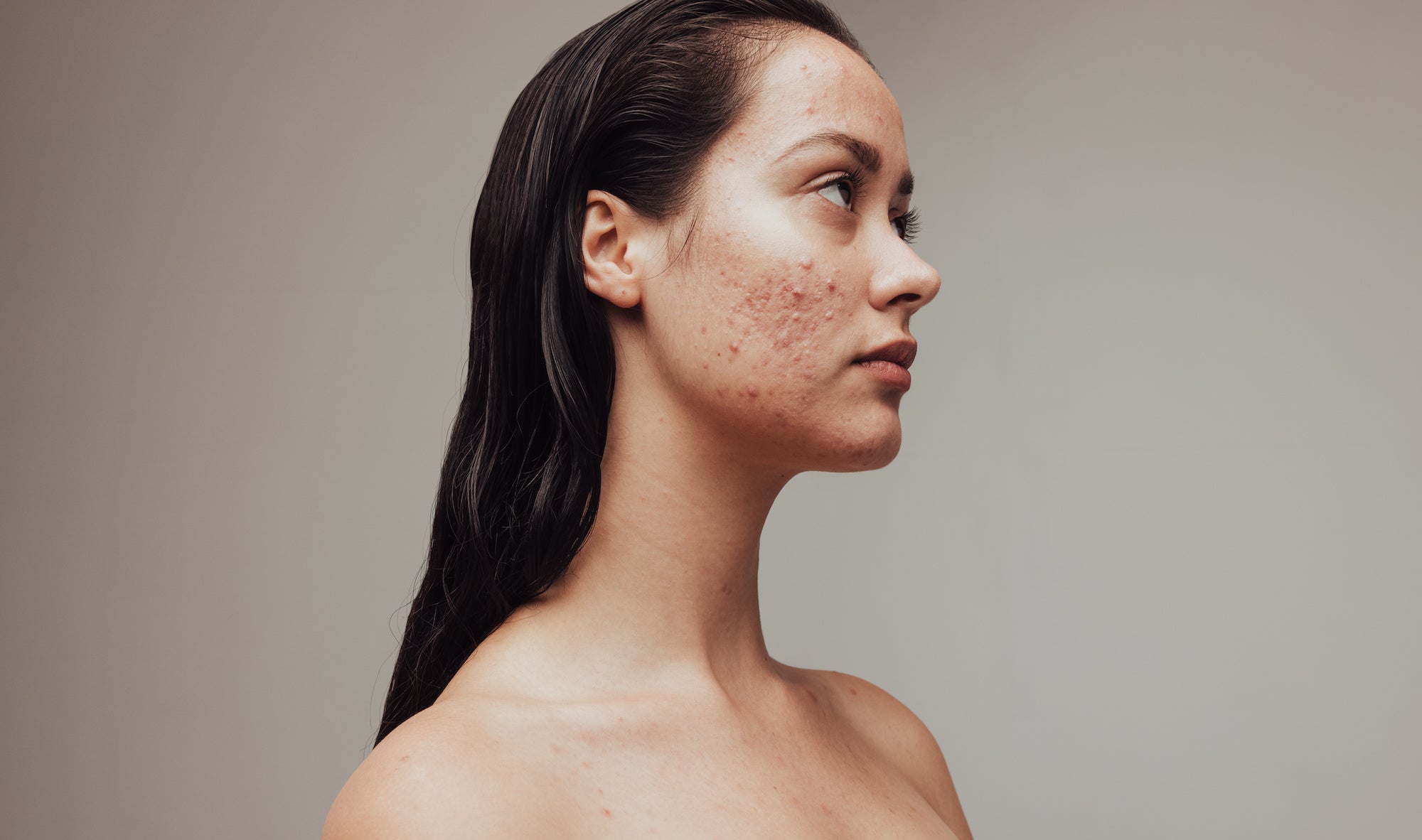5 Things You Didn't Know About Acne