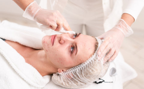 Unlock Clear Skin: Discover the Best Acne Treatments Only Your Doctor Can Perform