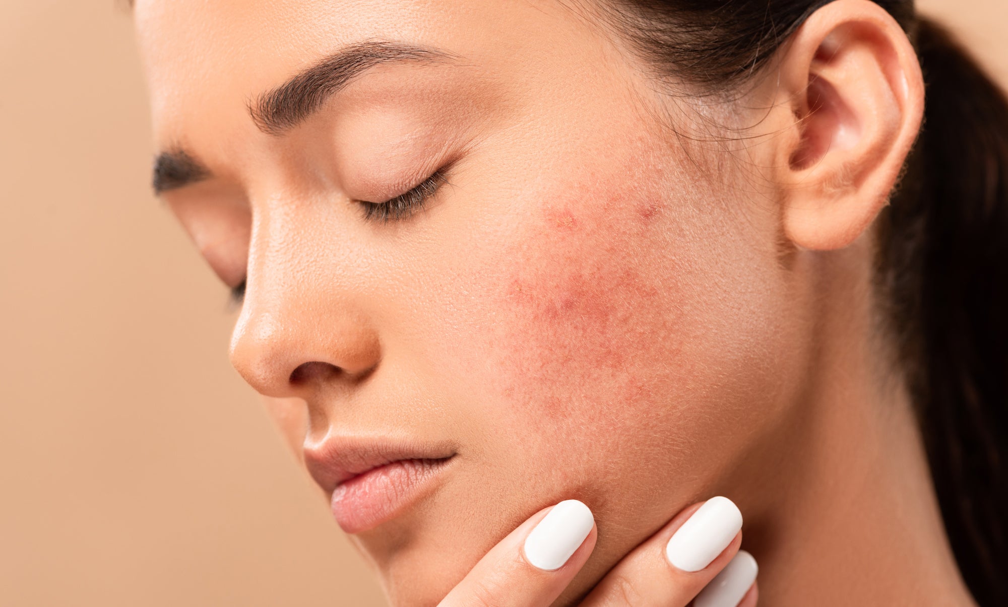 DIY Acne Treatments You Should Avoid and What To Do Instead