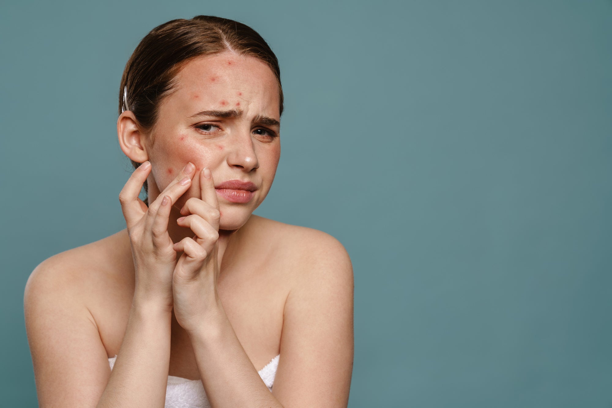 How to Deal With Purging From Chemical Peels – Oxygenetix