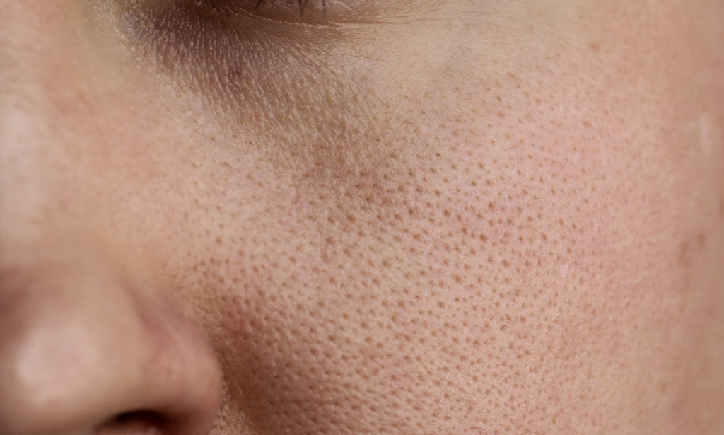 Understanding How Pores Get Clogged So You Can Prevent Skin Issues ...