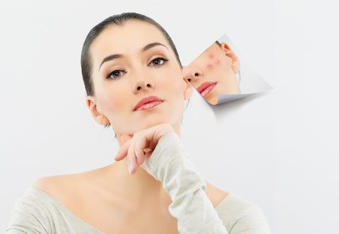 Learn to Tame Adult Acne