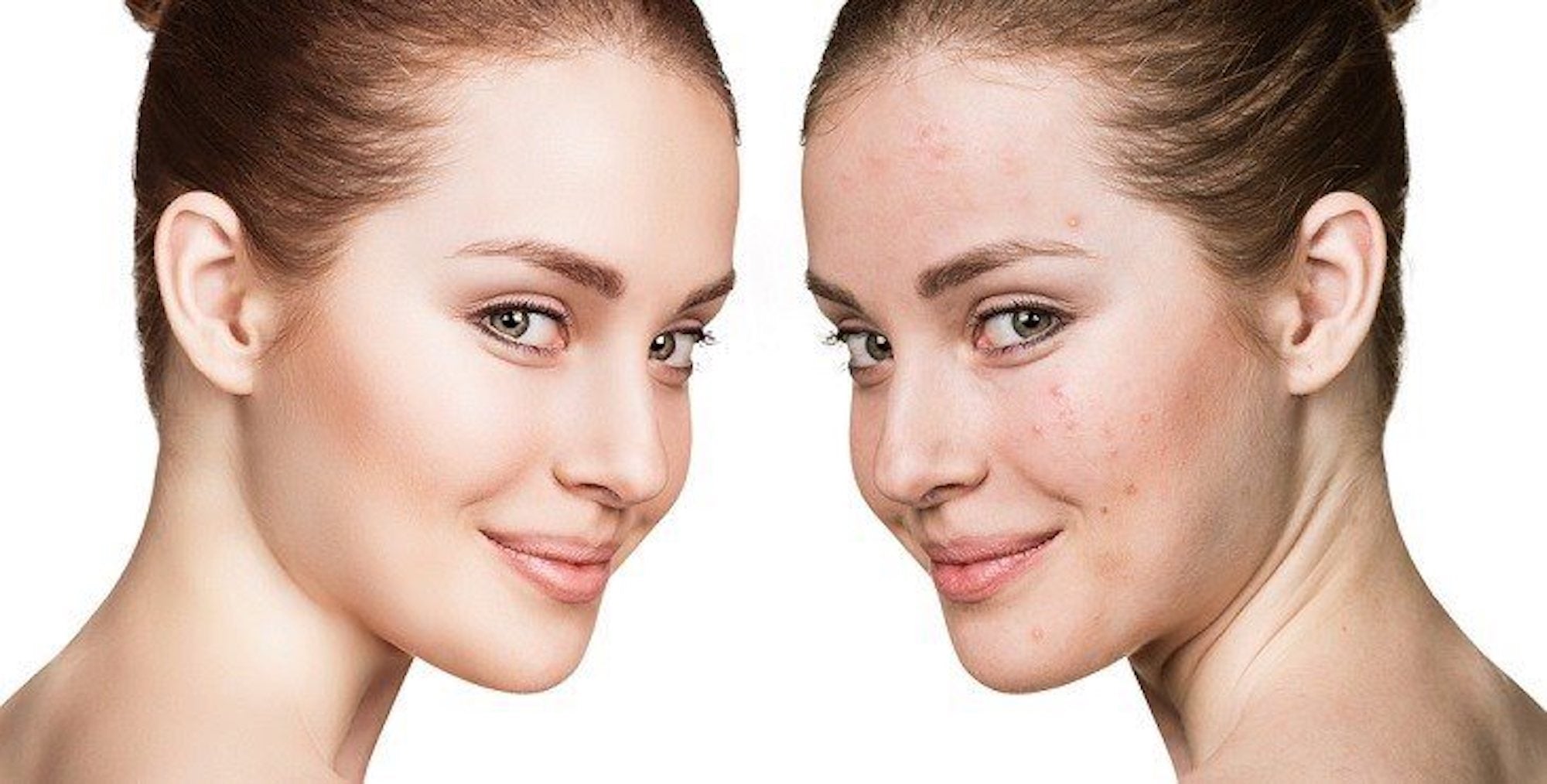 Acne-Prone Skin Care 8 Essential Products