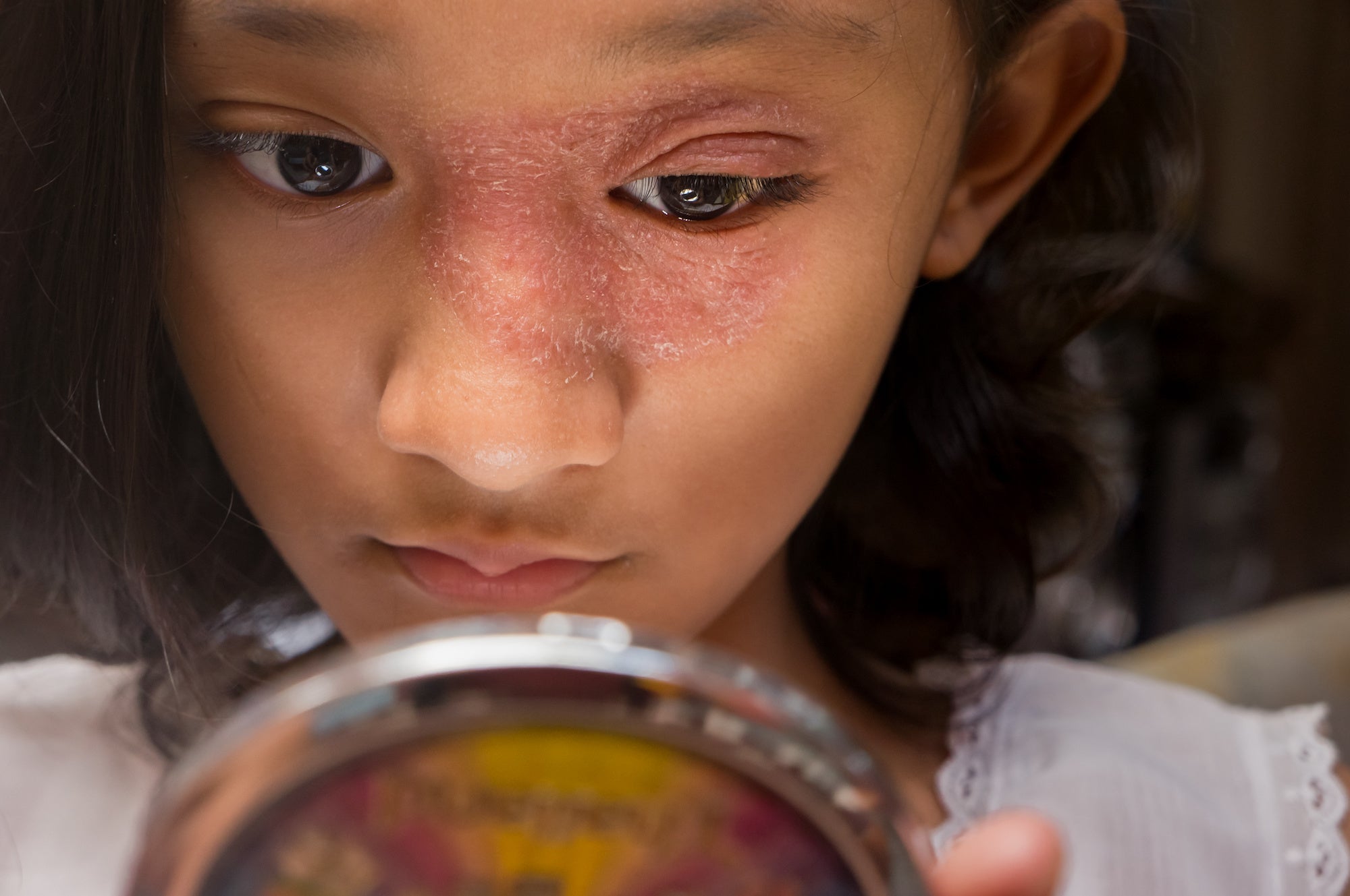Getting Under the Skin | The Link Between Skin Conditions and Childhood Bullying