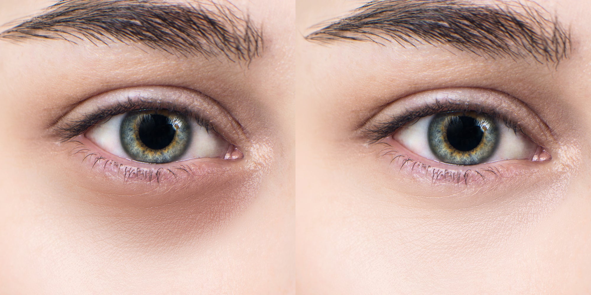 5 Reasons You Have Dark Under Eye Circles & How to Conceal Them
