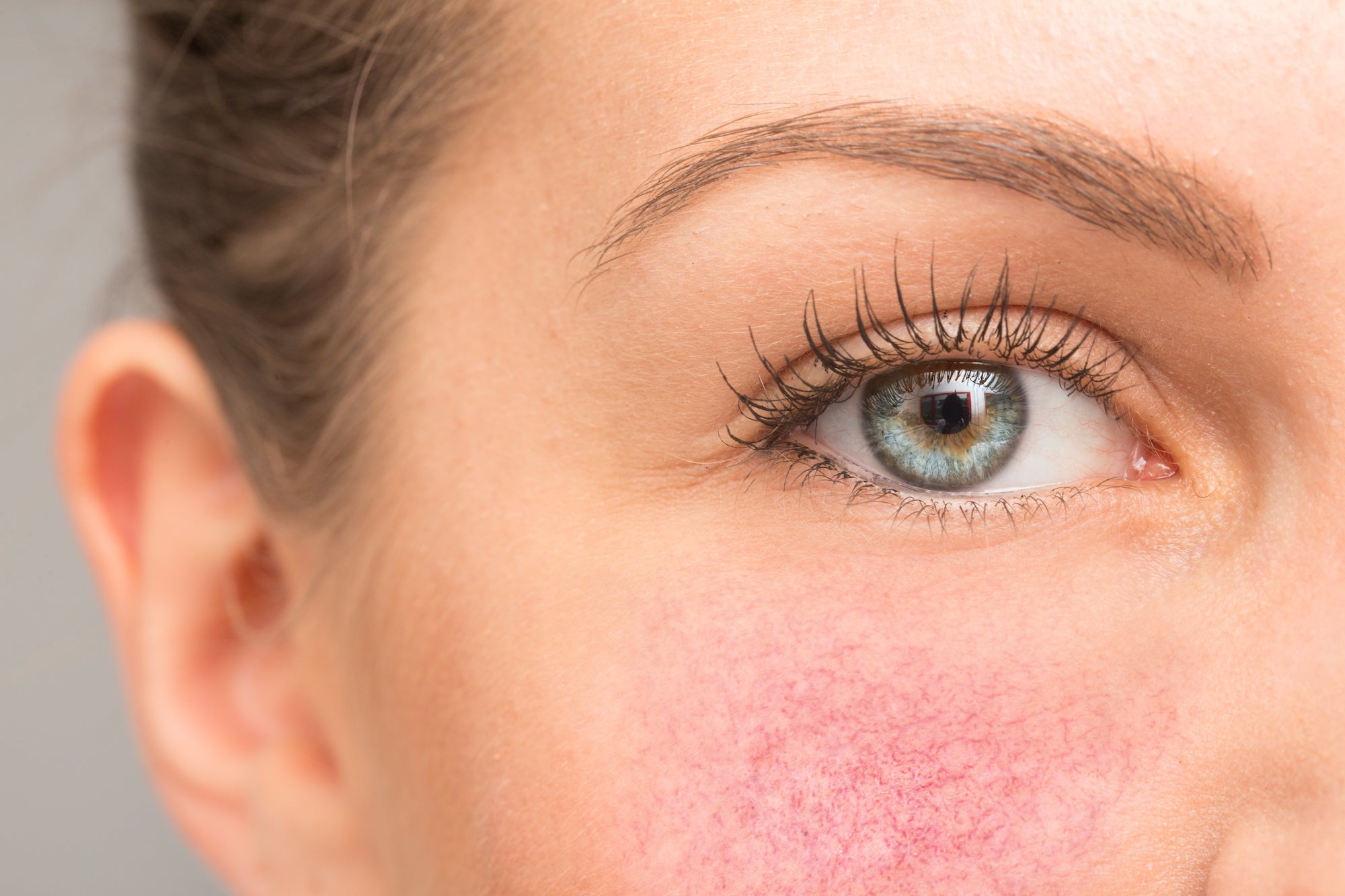 Rosacea: Symptoms, Causes, and Treatment