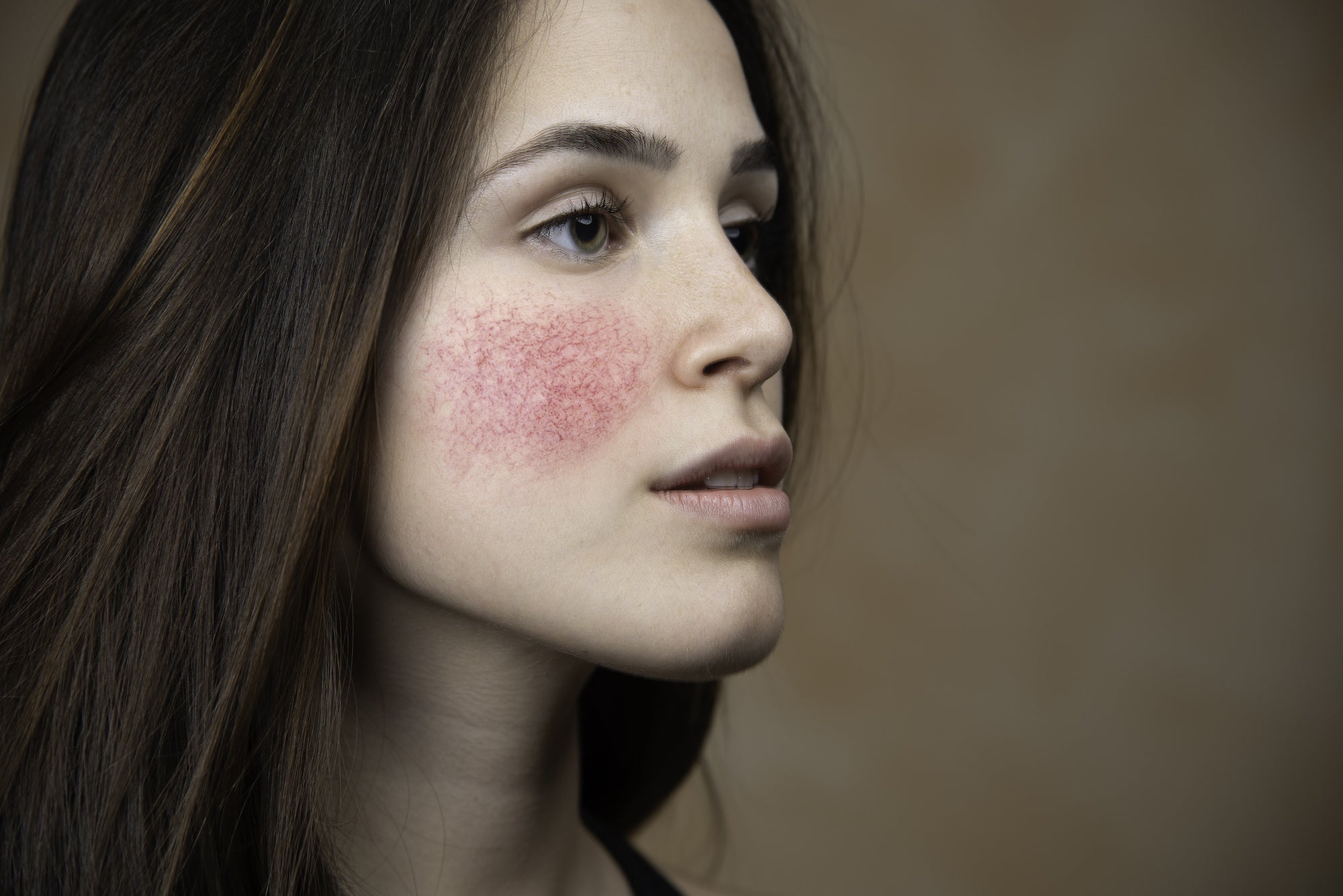 Rosacea Treatment Options From a Dermatologist