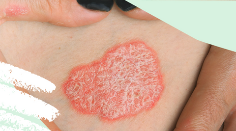 Everything you need to know about psoriasis – what causes it, what makes it worse, and how to soothe it